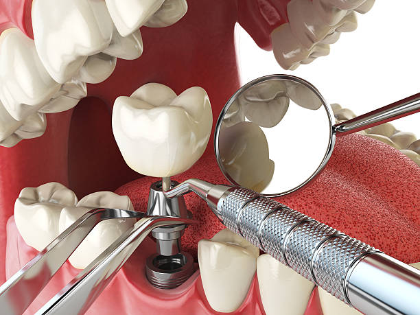 Best Emergency Tooth Extraction in Black Rock, NM
